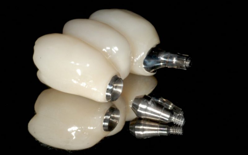 Ryc. 127. Połączenie implant–łącznik (uniabutment) zawsze zapewnia pasywność. Ryzyko powstania naprężeń przenosi się powyżej szyjki implantu – na śrubę finalną uniabutmentu lub na strukturę.