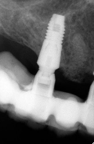 Ryc. 15. Zdjęcie RVG od zęba 16 do zęba 25. Pomimo awarii pracy implanty są w bardzo dobrym stanie.