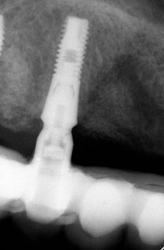 Ryc. 16. Zdjęcie RVG od zęba 16 do zęba 25. Pomimo awarii pracy implanty są w bardzo dobrym stanie.