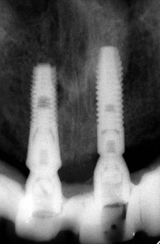 Ryc. 17. Zdjęcie RVG od zęba 16 do zęba 25. Pomimo awarii pracy implanty są w bardzo dobrym stanie.