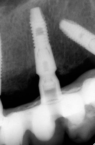 Ryc. 18. Zdjęcie RVG od zęba 16 do zęba 25. Pomimo awarii pracy implanty są w bardzo dobrym stanie.