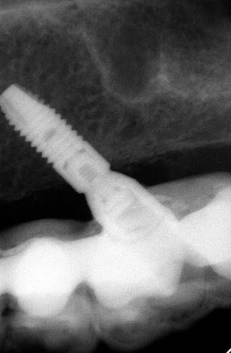 Ryc. 19. Zdjęcie RVG od zęba 16 do zęba 25. Pomimo awarii pracy implanty są w bardzo dobrym stanie.