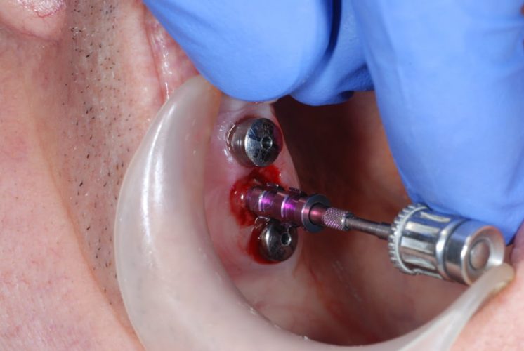 Ryc. 26. Kwadrant I – usunięcie implantu w projekcji zęba 15. Pierwsza faza – montaż przenośnika.