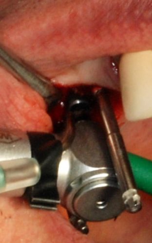 Ryc. 33–35. Kwadrant I – po około 6 miesiącach wszczepienie nowego implantu w projekcji 15.