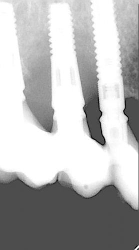 Ryc. 46. Kwadrant I – stan zapalny wokół implantu w projekcji 15 (zdjęcie RVG do rycin 26 i 27).