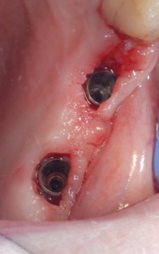 Ryc. 54. Kwadrant I – widok okluzyjny implantów po usunięciu tkanki zapalnej.