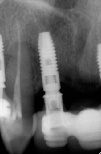 Ryc. 58. Ząb 13 i implant 12. Widoczny zanik kostny przy implancie.