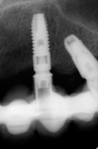 Ryc. 60. Implanty w projekcji 24 i skośnie – w celu ominięcia zatoki 26. Zaniki kostne.
