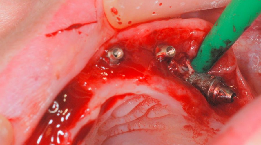 Ryc. 68. Implanty wypolerowano – implantoplastyka. Widoczne beleczki kostne.