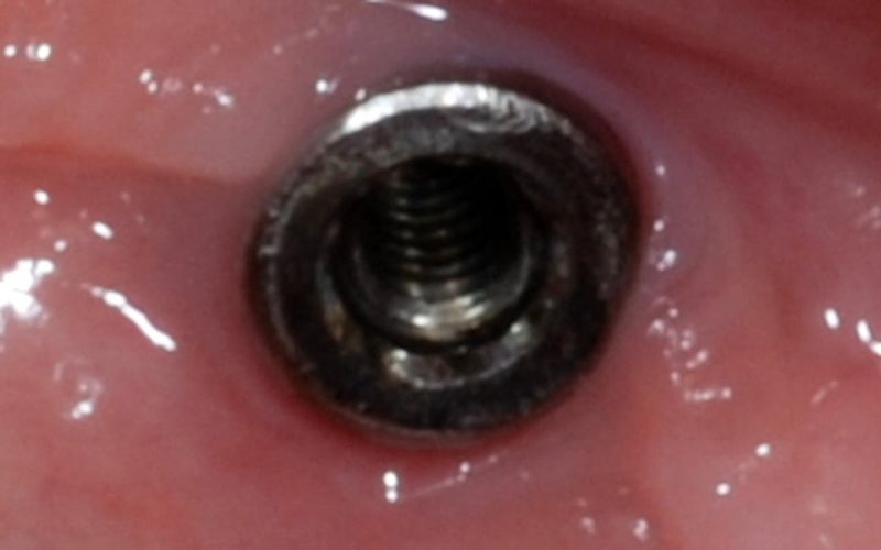 Ryc. 82. Interfejs implantu po usunięciu pękniętej śruby.