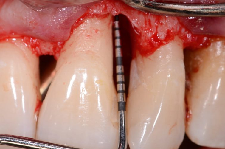 Ryc. 74. Śródzabiegowe sondowanie ubytku kości, głębokość do brzegu kości na dystalnej zęba 21 – 5 mm, odległość od dna do brzegu wyrostka na mezjalnej stronie 22 – 9 mm.