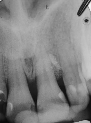 Ryc. 97. Zdjęcie radiologiczne obrazujące wypełnienie ubytku, wykonane 6 miesięcy po zabiegu.