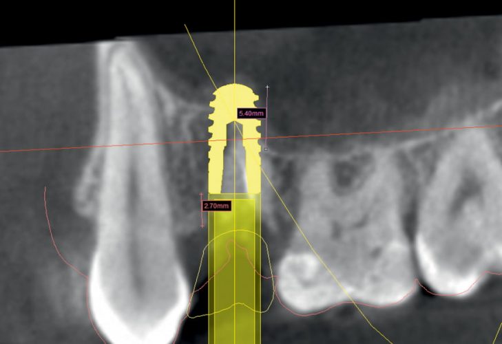 Ryc. 11. Użycie narzędzia View implant-centric image w celu precyzyjnego zmierzenia głębokości pogrążenia implantu w zatoce szczękowej.