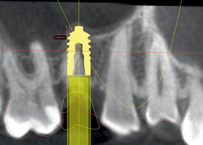 Ryc. 12. Użycie narzędzia View implant-centric image w celu precyzyjnego zmierzenia głębokości pogrążenia implantu w zatoce szczękowej.