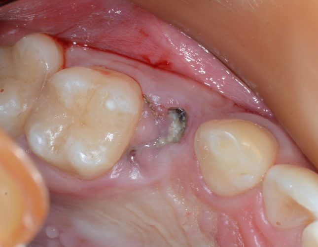 Ryc. 13. Próchnicowo zniszczony korzeń zęba 24 zakwalifikowany do ekstrakcji.