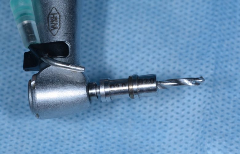 Ryc. 17. Tuleje dystansujące o wysokości 6 mm, nałożone na wiertło pilotowe w procedurze Safe Guide – system implantologiczny Ankylos®.