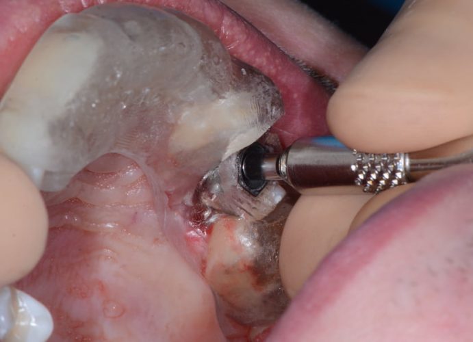 Ryc. 21. Podniesienie dna zatoki szczękowej metodą zamkniętą przy pomocy osteotomów i szablonu chirurgicznego.