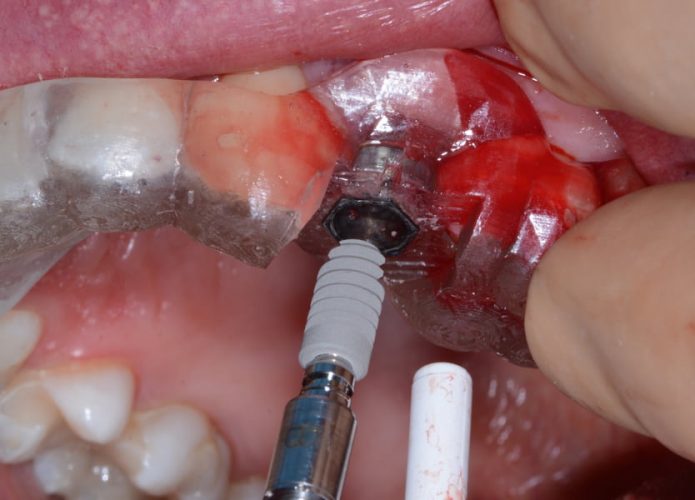 Ryc. 25. Wprowadzenie implantu Ankylos® przy pomocy szablonu chirurgicznego.