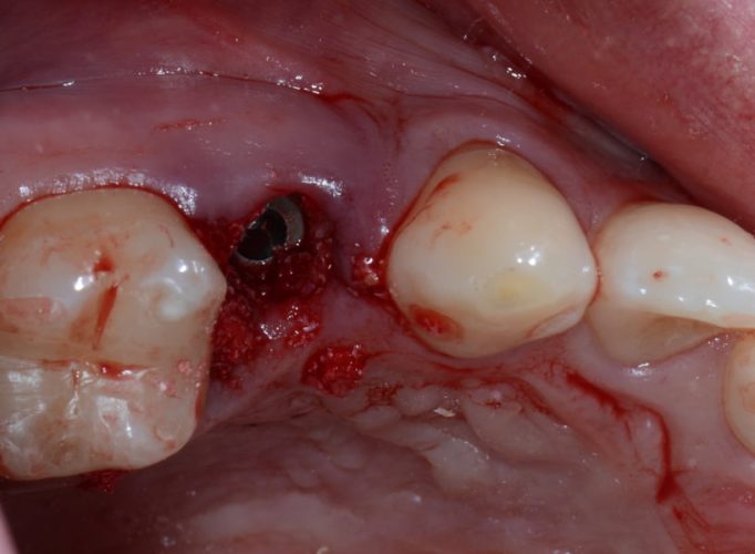 Ryc. 26. Implant Ankylos® pogrążony w zębodole poekstrakcyjnym.