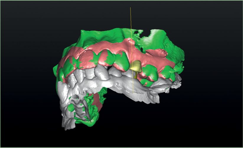 Ryc. 4. Nałożenie skanu optycznego wew- nątrzustnego wraz z zębami przeciwstawnymi na badanie tomografii wolumetrycznej (CBCT).