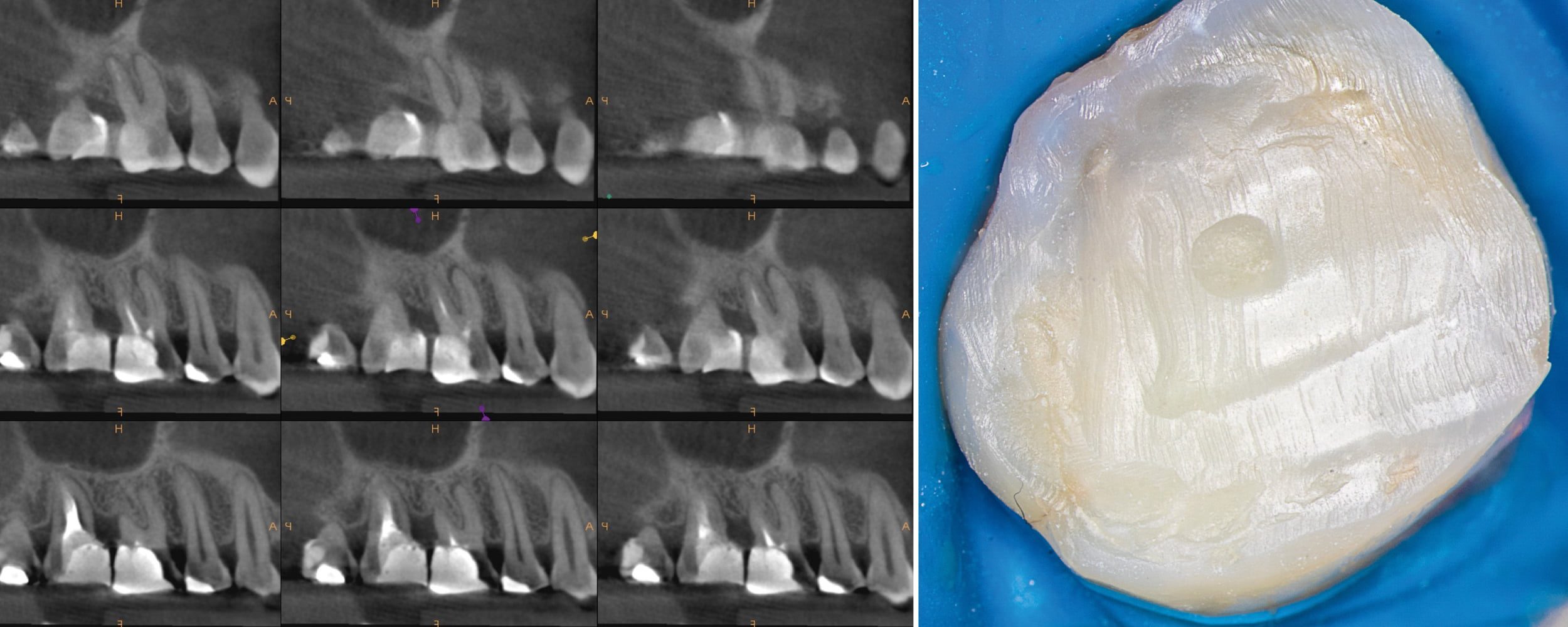 Przypadek 1 | Ryc. 2. Skany z tomografii komputerowej przed zabiegiem oraz widok zęba przed zabiegiem. W korzeniu mezjalnym widoczne światło kanałów MB1 i MB2. Widoczne ognisko osteolityczne przy wierzchołku korzenia MB.