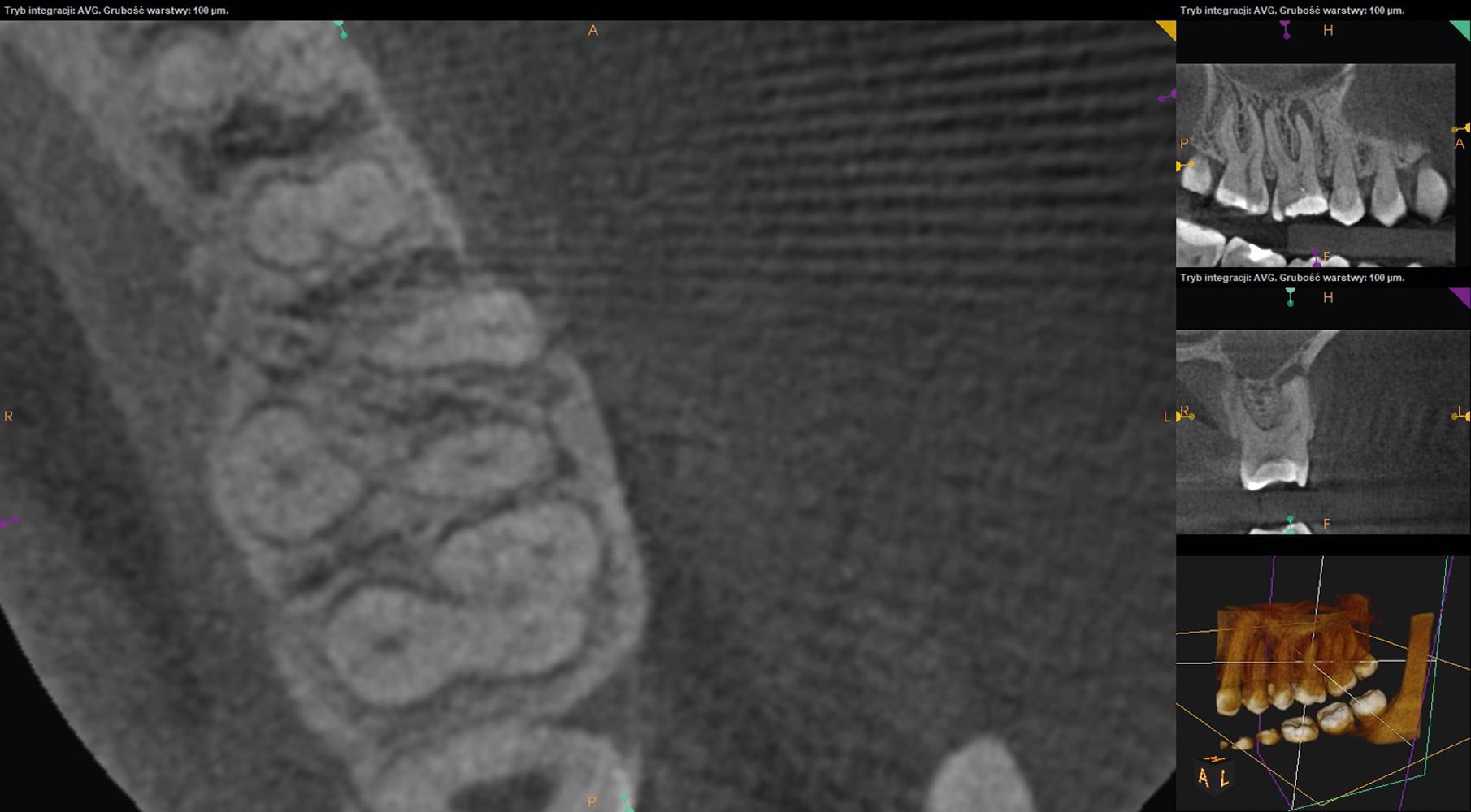 Przypadek 3 | Ryc. 14. Skan z tomografii komputerowej w płaszczyźnie poprzecznej w połowie długości korzenia. W korzeniu mezjalnym widoczne przejaśnienia sugerujące obecność dwóch, osobnych kanałów.