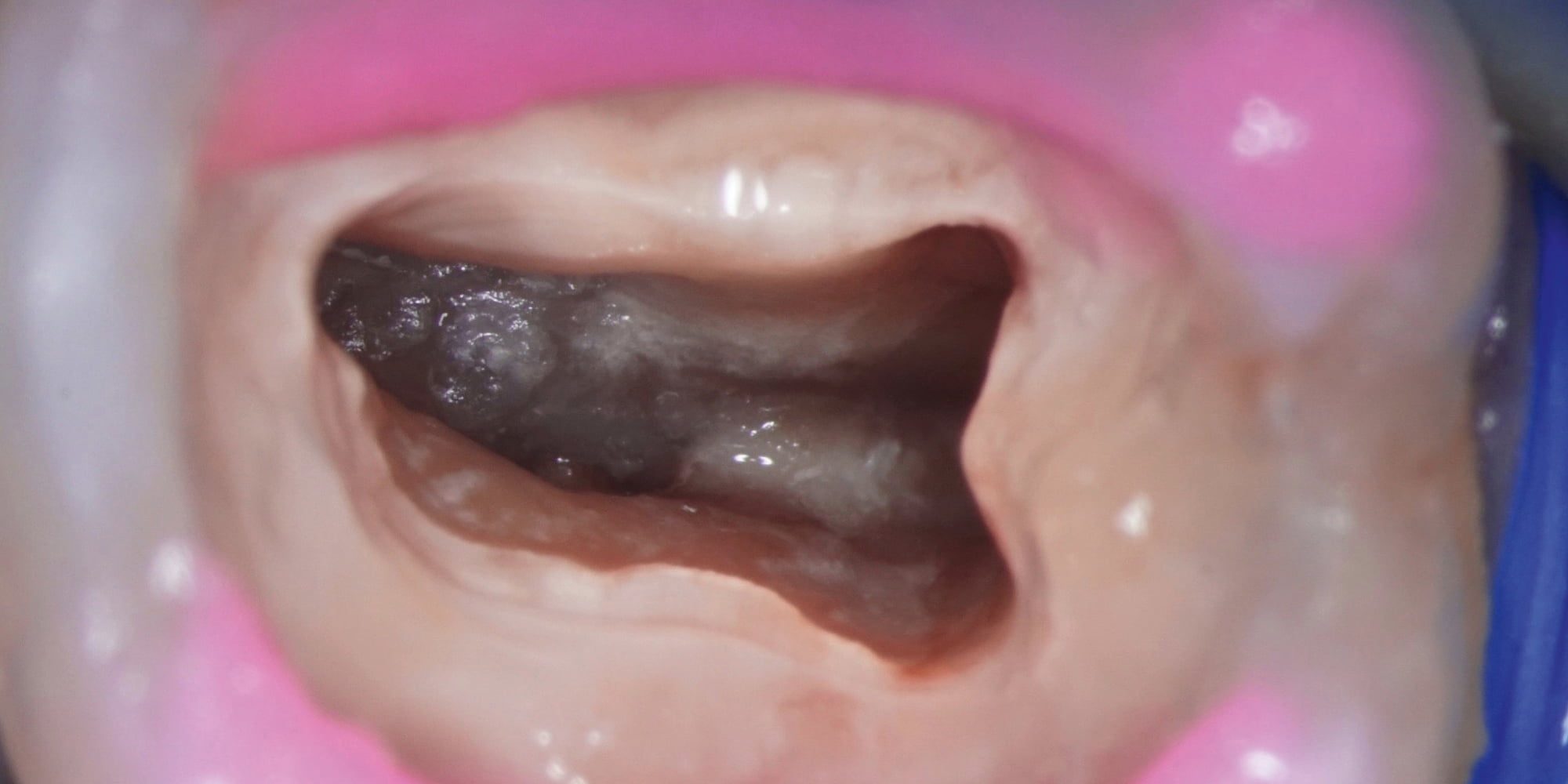 Przypadek 3 | Ryc. 16. Widok komory po usunięciu zębiniaka i płukaniu podchlorynem sodu.