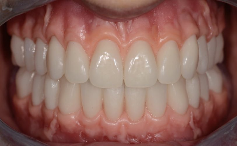 Ryc. 12. Przymiarka protezy woskowej w ustach pacjenta.