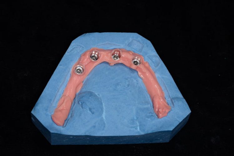 Ryc. 23–27. Model gipsowy wykonany z szablonu chirurgicznego w celu wykonania otworów na czapeczki SynCone® w protezie.