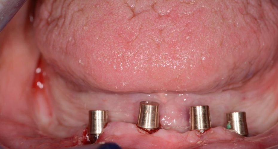 Ryc. 33. Czapeczki SynCone® zamontowane na elementach retencyjnych przed zacementowaniem w jamie ustnej.