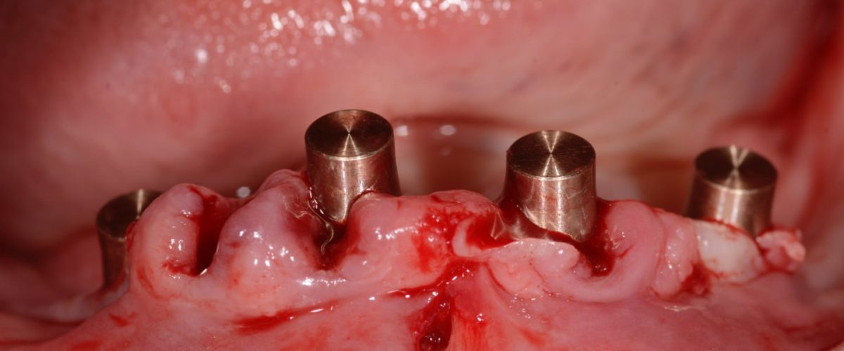 Ryc. 70. Czapeczki mocowane do protezy przygotowane do cementowania w ustach pacjenta.