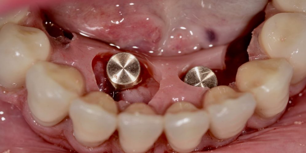 Ryc. 71. Proteza osadzona w jamie ustnej pacjenta gotowa do mocowania matryc.