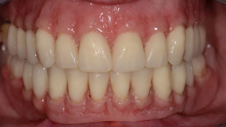 Ryc. 73. Efekt końcowy po osadzeniu protez w jamie ustnej pacjentki.