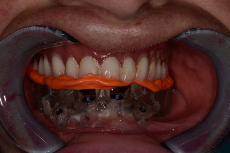 Ryc. 83–85. Szablon i jego fiksowanie w ustach pacjenta.