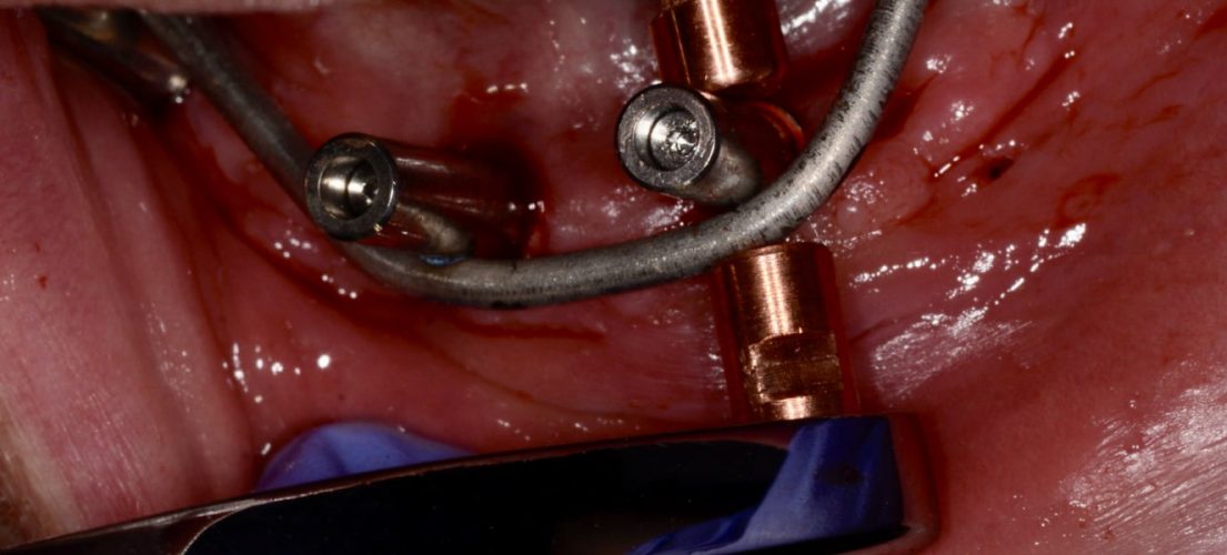 Ryc. 92. Proces zgrzewania drutu w jamie ustnej przy pomocy WeldOneTM.