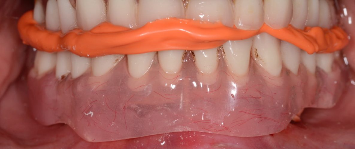 Ryc. 96. Sprawdzenie pozycji protezy w ustach z przykręconą konstrukcję tytanową.