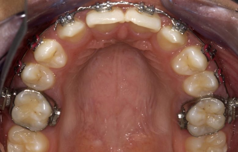 Ryc. 17. Korekta kształtu koron zębów metodami zachowawczymi.