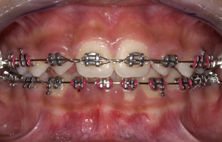 Ryc. 18. Korekta kształtu koron zębów metodami zachowawczymi.