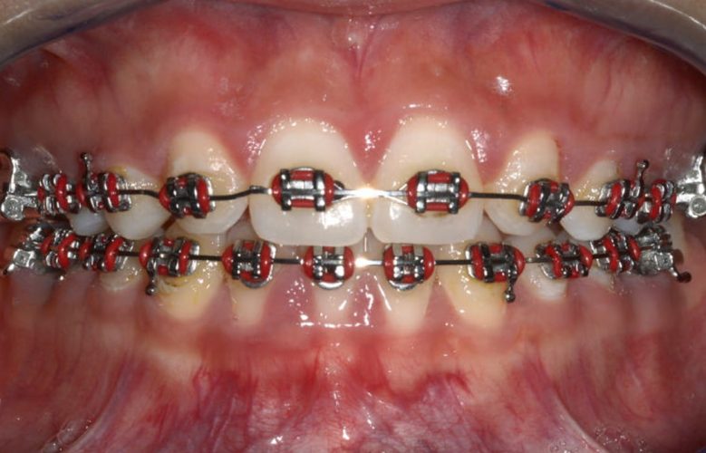 Ryc. 19. Korekta kształtu koron zębów metodami zachowawczymi.