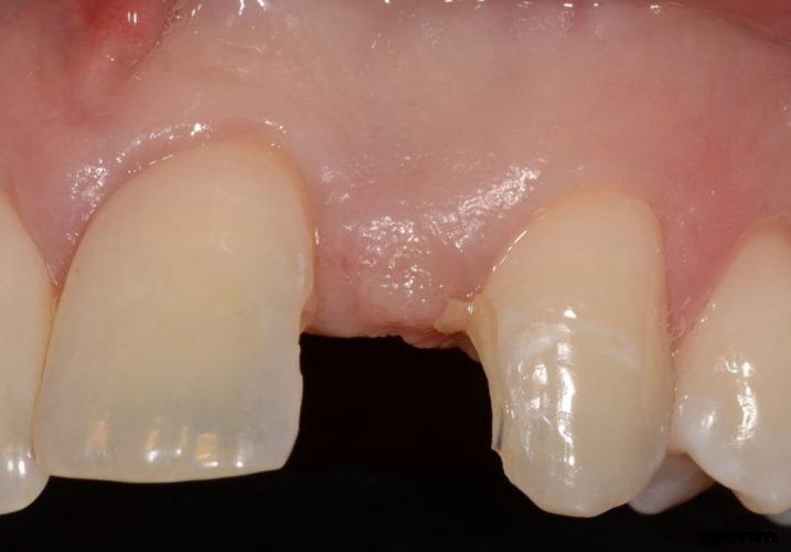 Ryc. 22. Stan po leczeniu ortodontycznym. Brak zawiązka zęba siecznego bocznego. Pacjent dorosły.