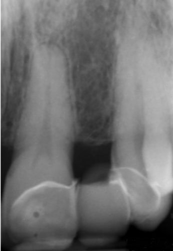 Ryc. 23. Stan po leczeniu ortodontycznym. Brak zawiązka zęba siecznego bocznego. Pacjent dorosły.